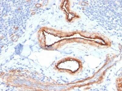 Immunohistochemistry-Paraffin: MTF1 Antibody (MTF1/2649) [NBP3-07236] - Formalin-fixed, paraffin-embedded human Renal Cell Carcinoma stained with MTF1 Mouse Monoclonal Antibody (MTF1/2649).