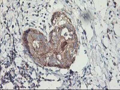 Immunohistochemistry: MTFMT Antibody (OTI1E7) - Azide and BSA Free [NBP2-72801] - Staining of paraffin-embedded Adenocarcinoma of Human breast tissue using anti-MTFMT mouse monoclonal antibody.