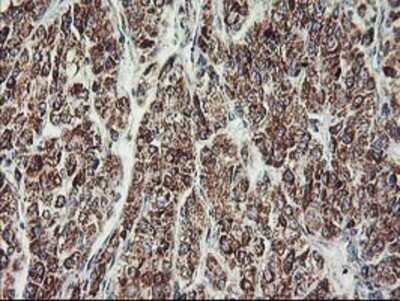 Immunohistochemistry: MTFMT Antibody (OTI1E7) - Azide and BSA Free [NBP2-72801] - Staining of paraffin-embedded Carcinoma of Human liver tissue using anti-MTFMT mouse monoclonal antibody.