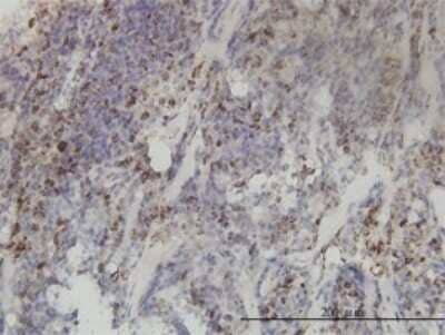 Immunohistochemistry-Paraffin: MTHFD2 Antibody (4G7-2G3) [H00010797-M01] - Analysis of monoclonal antibody to MTHFD2 on formalin-fixed paraffin-embedded human lymphoma tissue. Antibody concentration 3 ug/ml.