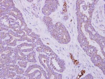 Immunohistochemistry-Paraffin: MTMR14 Antibody [NBP1-32416] - Paraffin-embedded Colon ca, using antibody at 1:500 dilution.