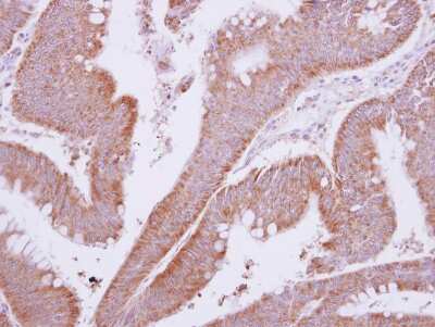 Immunohistochemistry-Paraffin: MTMR9 Antibody [NBP2-19435] - Immunohistochemical analysis of paraffin-embedded Colon ca, using antibody at 1:500 dilution.