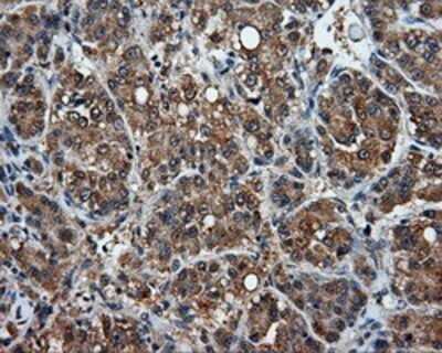 Immunohistochemistry: MTRF1L Antibody (OTI1D11) - Azide and BSA Free [NBP2-72814] - Staining of paraffin-embedded Carcinoma of liver tissue using anti-MTRF1L mouse monoclonal antibody.