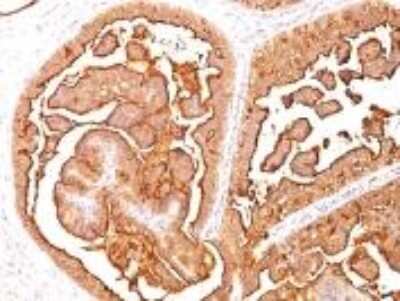 Immunohistochemistry-Paraffin: MUC1 Antibody (E29) [NBP2-44663] - Formalin-fixed, paraffin-embedded human breast carcinoma stained with MUC-1/EMA monoclonal antibody (E29).