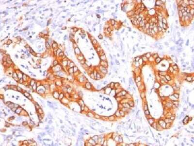 Immunohistochemistry-Paraffin: MUC1 Antibody (GP1.4 + E29) - Azide and BSA Free [NBP2-34624] - Formalin-fixed, paraffin-embedded human colon Carcinoma stained with MUC-1/EMA Monoclonal Antibody (GP1.4 +E29).