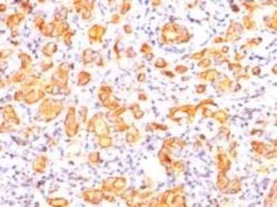 Immunohistochemistry-Paraffin: MUC1 Antibody (GP1.4) - IHC-Prediluted [NBP2-44661] - Formalin-paraffin human breast cancer stained with EMA Ab (GP1.4). Note cytoplasmic and membrane staining.