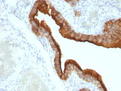 Immunohistochemistry-Paraffin: MUC1 Antibody (HMPV) - IHC-Prediluted [NBP2-48359] - Formalin-fixed, paraffin-embedded human Ovarian Carcinoma stained with MUC-1 / CA15-3 / EMA Mouse Monoclonal Antibody (HMPV).