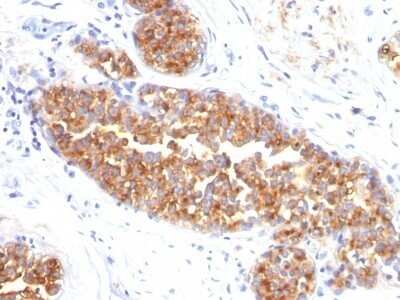 Immunohistochemistry-Paraffin: MUC1 Antibody (MUC1/845) [NBP2-44655] - Human Breast Carcinoma stained with MUC1 / EMA Monoclonal Antibody (MUC1/845).