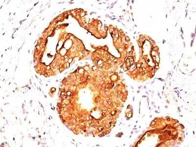 Immunohistochemistry-Paraffin: MUC1 Antibody (MUC1/845) [NBP2-44655] - Human Breast Carcinoma stained with MUC1 / EMA Monoclonal Antibody (MUC1/845).