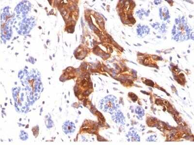 Immunohistochemistry-Paraffin: MUC1 Antibody (MUC1/845) [NBP2-44655] - Human Breast Carcinoma stained with MUC1 / EMA Monoclonal Antibody (MUC1/845).