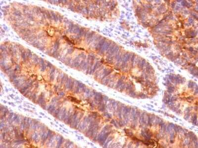 Immunohistochemistry-Paraffin: MUC1 Antibody (MUC1/845) [NBP2-44655] - Human Colon Carcinoma stained with MUC1 / EMA Monoclonal Antibody (MUC1/845).