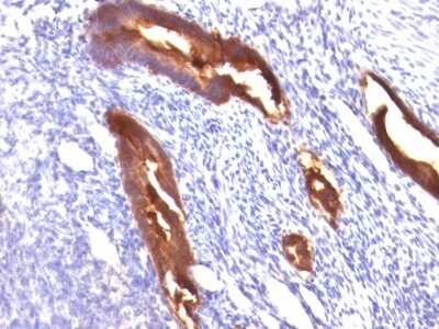 Immunohistochemistry-Paraffin: MUC1 Antibody (MUC1/845) [NBP2-44655] - Human Endometrial Carcinoma stained with MUC1 / EMA Monoclonal Antibody (MUC1/845).