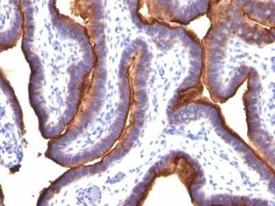 Immunohistochemistry-Paraffin: MUC1 Antibody (MUC1/845) [NBP2-44655] - Human Ovarian Carcinoma stained with MUC1 / EMA Monoclonal Antibody (MUC1/845).