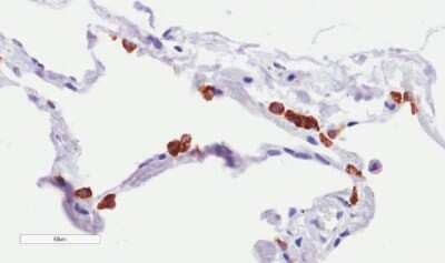 Immunohistochemistry: MUC1 Antibody (SM3) - Chimeric [NBP2-62561] - Immunohistochemical staining of human lung tissue using anti-MUC1 antibody. SM3 Anti-MUC1 (Mucin-1) staining of paraffin embedded human lung tissue using the rabbit-chimeric version of SM3 (NBP2-62561). Antigen retreival was acheived by microwaving in citrate buffer (pH6), followed by blocking with protein block serum-free buffer. Primary antibody incubation with NBP2-62561 was carried out at 4 ug/ml for 30 minutes. Samples were then incubated with an anti-rabbit IgG HRP secondary antibody for 20 mins followed by DAB (3,3'-diaminobenzidine), and counter-staining with haemotoxylin. Staining of type II pneumocytes may be observed. Recommended concentration, 2-4 ug/ml.