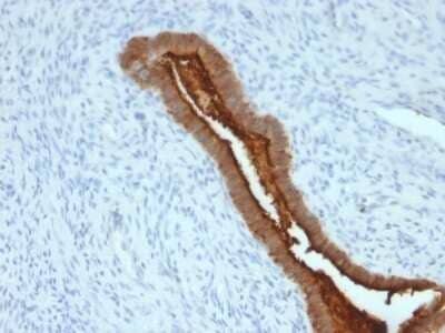 Immunohistochemistry-Paraffin: MUC1 Antibody (SPM492) [NBP2-44667] - Human Endometrial Carcinoma stained with EMA Monoclonal Antibody (SPM492).