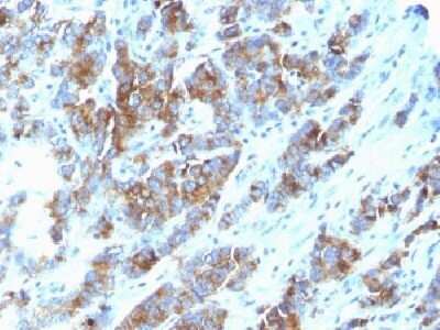 Immunohistochemistry-Paraffin: MUC1 Antibody (SPM533) - Azide and BSA Free [NBP2-34782] - Formalin-fixed, paraffin-embedded human Breast Carcinoma stained with MUC-1/ EMA Monoclonal Antibody (SPM533).