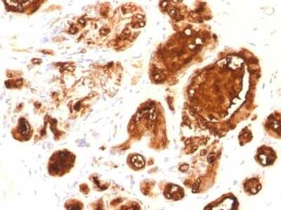 Immunohistochemistry-Paraffin: MUC1 Antibody (rMUC1/960) [NBP2-53286] - Formalin-fixed, paraffin-embedded human Ovarian Carcinoma stained with EMA Recombinant Mouse Monoclonal Antibody (MUC1/960).