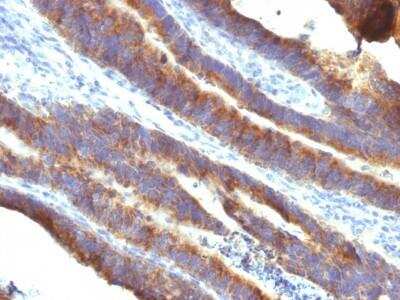 Immunohistochemistry-Paraffin: MUC3 Antibody (M3.1) - Azide and BSA Free [NBP2-47686] - Human Colon Carcinoma stained with MUC3 Monoclonal Antibody (M3.1).