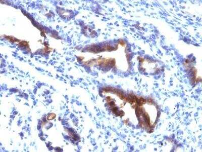 Immunohistochemistry-Paraffin: MUC3 Antibody (M3.1) - Azide and BSA Free [NBP2-47686] - Human Gastric Carcinoma stained with MUC3 Monoclonal Antibody (M3.1).