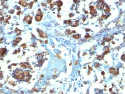 Immunohistochemistry-Paraffin: MUC3 Antibody (M3.1) - IHC-Prediluted [NBP2-48392] - Formalin-fixed, paraffin-embedded human Gastric Carcinoma stained with MUC3 Mouse Monoclonal Antibody (M3.1).
