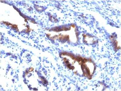 Immunohistochemistry-Paraffin: MUC3 Antibody (M3.1) - IHC-Prediluted [NBP2-48392] - Formalin-fixed, paraffin-embedded human Gastric Carcinoma stained with MUC3 Mouse Monoclonal Antibody (M3.1).