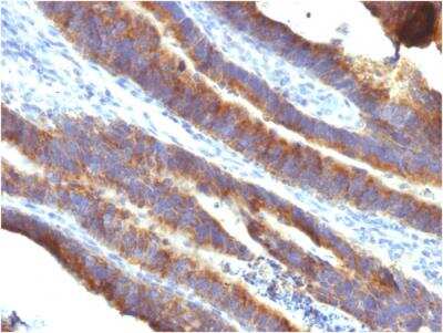 Immunohistochemistry-Paraffin: MUC3 Antibody (M3.1) - IHC-Prediluted [NBP2-48392] - Formalin-fixed, paraffin-embedded human Colon Carcinoma stained with MUC3 Mouse Monoclonal Antibody (M3.1).