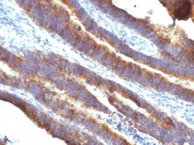 Immunohistochemistry-Paraffin: MUC3 Antibody (M3.1) [NBP2-44432] - Human Colon Carcinoma stained with MUC3 Monoclonal Antibody (M3.1).