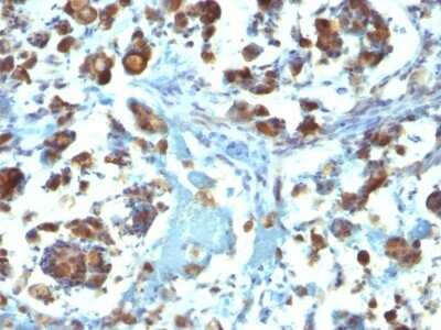 Immunohistochemistry-Paraffin: MUC3 Antibody (M3.1) [NBP2-44432] - Human Gastric Carcinoma stained with MUC3 Monoclonal Antibody (M3.1).