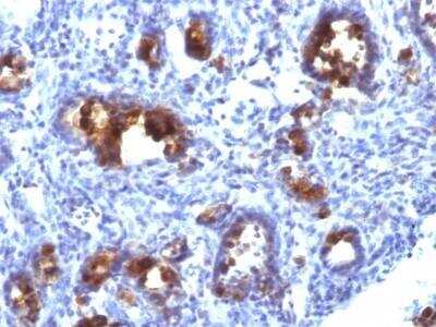 Immunohistochemistry-Paraffin: MUC3 Antibody (MUC3/1154) - Azide and BSA Free [NBP2-47687] - Human Gastric Carcinoma stained with MUC3 Monoclonal Antibody (MUC3/1154).