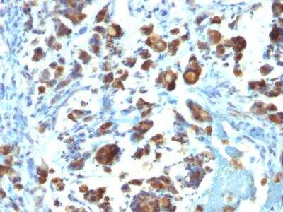 Immunohistochemistry-Paraffin: MUC3 Antibody (MUC3/1154) - IHC-Prediluted [NBP2-48415] - Formalin-fixed, paraffin-embedded human Gastric Carcinoma stained with MUC3 Monoclonal Antibody (MUC3/1154).