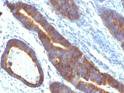 Immunohistochemistry-Paraffin: MUC3 Antibody (MUC3/1154) - IHC-Prediluted [NBP2-48415] - Formalin-fixed, paraffin-embedded human Colon Carcinoma stained with MUC3 Monoclonal Antibody (MUC3/1154).