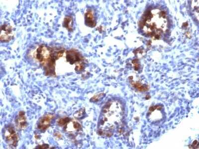 Immunohistochemistry-Paraffin: MUC3 Antibody (MUC3/1154) [NBP2-44434] - Human Gastric Carcinoma stained with MUC3 Monoclonal Antibody (MUC3/1154).