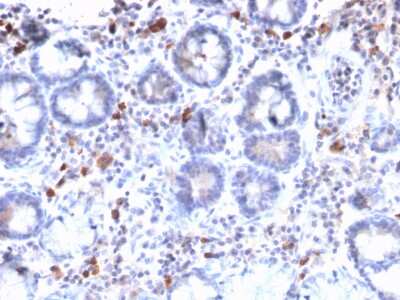 Immunohistochemistry-Paraffin: MUC3 Antibody (MUC3/2992R) - Azide and BSA Free [NBP3-08351] - Formalin-fixed, paraffin-embedded human Gastric Carcinoma stained with MUC3 Rabbit Recombinant Monoclonal Antibody (MUC3/2992R).