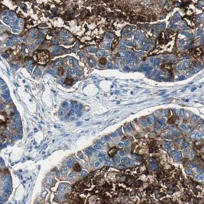 Immunohistochemistry-Paraffin: MUC4 Antibody [NBP1-86505] - Staining of human lung cancer, adenocarcinoma shows moderate cytoplasmic positivity in tumor cells.