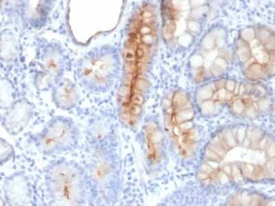 Immunohistochemistry-Paraffin: MUC4 Antibody (MUC4/3084) [NBP2-79731] - Formalin-fixed, paraffin-embedded human Gastric Carcinoma stained with MUC4 Antibody (MUC4/3084).