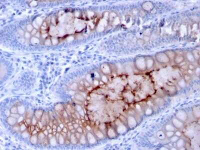 Immunohistochemistry-Paraffin: MUC4 Antibody (MUC4/3084) [NBP2-79731] - Formalin-fixed, paraffin-embedded human Colon Carcinoma stained with MUC4 Antibody (MUC4/3084).