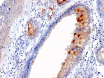 Immunohistochemistry-Paraffin: MUC4 Antibody (MUC4/3084) [NBP2-79731] - Formalin-fixed, paraffin-embedded human Gastric Carcinoma stained with MUC4 Antibody (MUC4/3084).