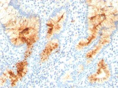 Immunohistochemistry-Paraffin: MUC4 Antibody (MUC4/3105) - Azide and BSA Free [NBP2-79867] - Formalin-fixed, paraffin-embedded human Gastric Carcinoma stained with MUC4 Mouse Monoclonal Antibody (MUC4/3105).