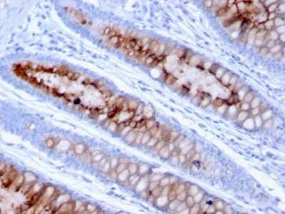 Immunohistochemistry-Paraffin: MUC4 Antibody (MUC4/3105) [NBP2-79732] - Formalin-fixed, paraffin-embedded human Colon Carcinoma stained with MUC4 Antibody (MUC4/3105).