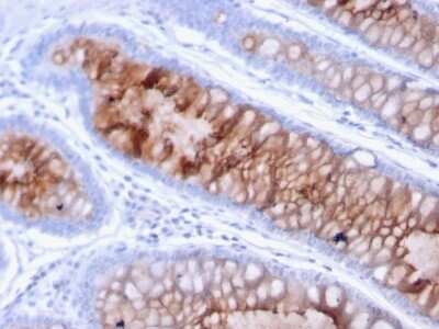 Immunohistochemistry-Paraffin: MUC4 Antibody (MUC4/3105) [NBP2-79732] - Formalin-fixed, paraffin-embedded human Colon Carcinoma stained with MUC4 Antibody (MUC4/3105).