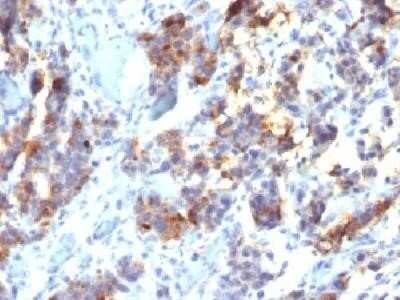 Immunohistochemistry-Paraffin: MUC5AC Antibody (45M1) - IHC-Prediluted [NBP2-44450] - Formalin-fixed, paraffin-embedded human Gastric Carcinoma stained with MUC5AC Monoclonal Antibody (45M1).