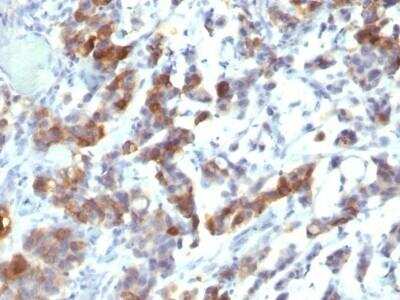 Immunohistochemistry-Paraffin: MUC5AC Antibody (MUC5AC/917 + 45M1) - Azide and BSA Free [NBP2-47696] - Human Gastric Carcinoma stained with MUC5AC Monoclonal Antibody (MUC5AC/917 + 45M1).