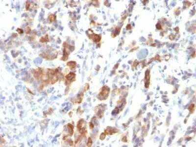Immunohistochemistry-Paraffin: MUC5AC Antibody (MUC5AC/917) - IHC-Prediluted [NBP2-48428] - Human Gastric Carcinoma stained with MUC5AC Monoclonal Antibody (MUC5AC/917).