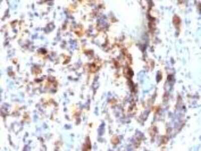 Immunohistochemistry-Paraffin: MUC5AC Antibody (SPM297) - Azide and BSA Free [NBP2-34758] - Paraffin-embedded human Gastric Carcinoma.