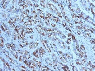 Immunohistochemistry-Paraffin: MUC6 Antibody (CLH5) - IHC-Prediluted [NBP2-48339] - Formalin-fixed, paraffin-embedded human Gastric Carcinoma stained with MUC6 Antibody (CLH5). Courtesy of Dr. Leonor David, IPATIMUP and Medical Faculty, University of Porto, Portugal
