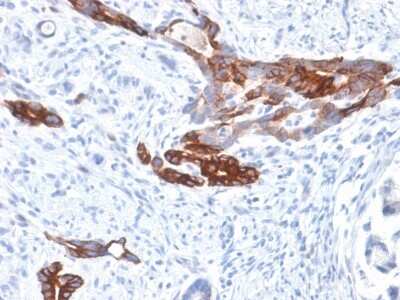 Immunohistochemistry-Paraffin: MUC6 Antibody (MUC6/1553R) - Azide and BSA Free [NBP3-08352] - Formalin-fixed, paraffin-embedded human Gastric Carcinoma stained with MUC6 Rabbit Recombinant Monoclonal Antibody (MUC6/1553R).