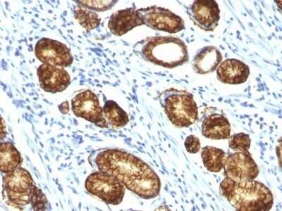 Immunohistochemistry-Paraffin: MUC6 Antibody (MUC6/916) - Azide and BSA Free [NBP2-47799] - Human Gastric Carcinoma stained with MUC6 Monoclonal Antibody (MUC6/916).
