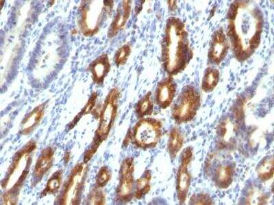Immunohistochemistry-Paraffin: MUC6 Antibody (MUC6/916) - IHC-Prediluted [NBP2-48368] - Formalin-fixed, paraffin-embedded human Gastric Carcinoma stained with MUC6 Monoclonal Antibody (MUC6/916).