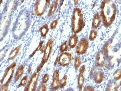 Immunohistochemistry-Paraffin: MUC6 Antibody (MUC6/916) [NBP2-44376] - Human Gastric Carcinoma stained with MUC6 Monoclonal Antibody (MUC6/916).