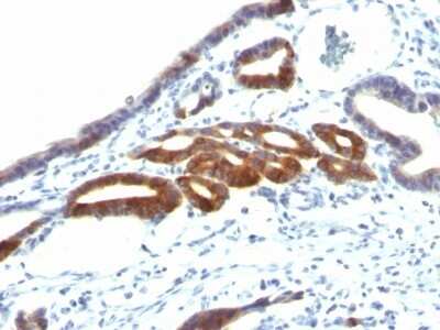 Immunohistochemistry-Paraffin: MUC6 Antibody (SPM598) [NBP2-44375] - Human Gastric Carcinoma stained with MUC6 Monoclonal Antibody (SPM598).